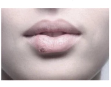 Избавление от ран, язв, герпеса